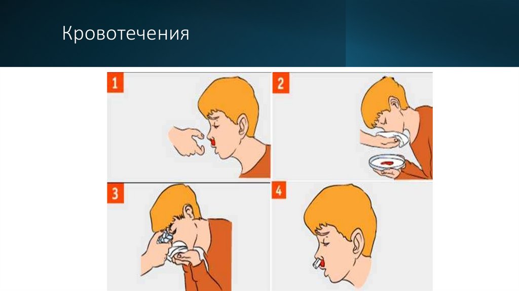 Кровотечения