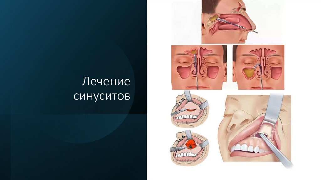 Лечение синуситов
