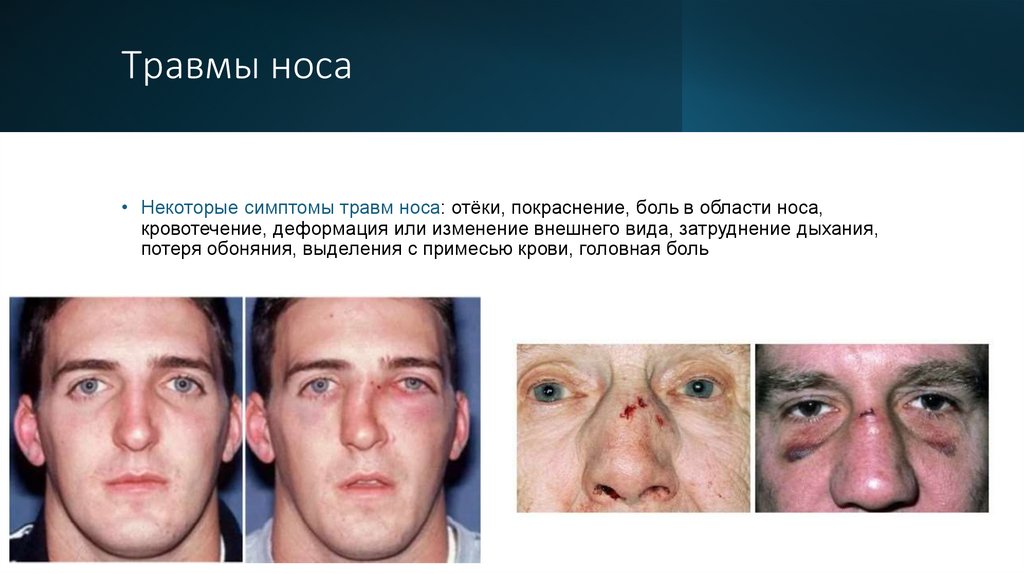 Травмы носа