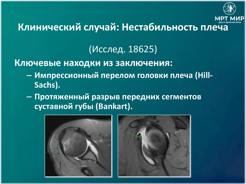Клинический случай: Нестабильность плеча