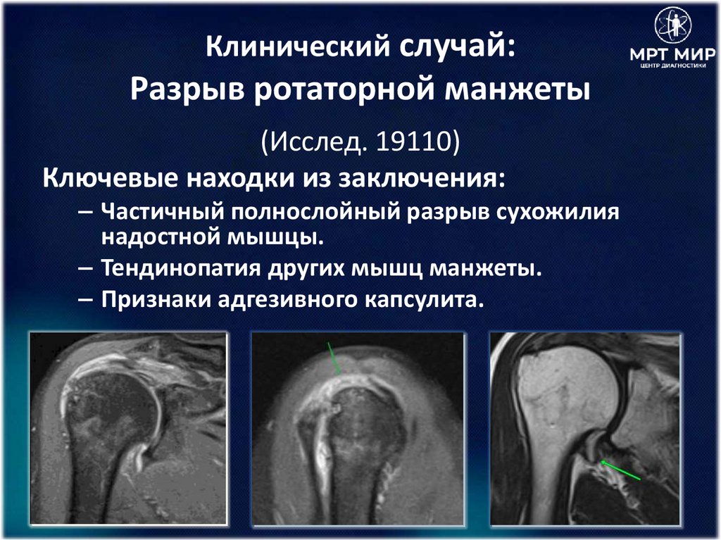 Клинический случай: Разрыв ротаторной манжеты