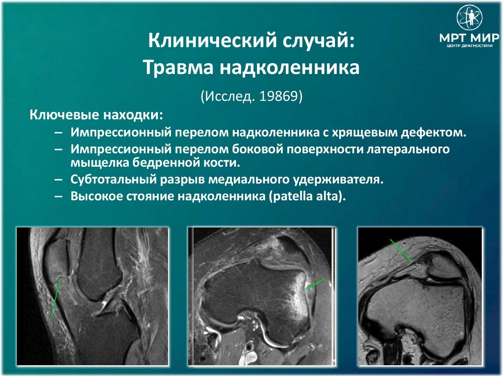 Клинический случай: Травма надколенника