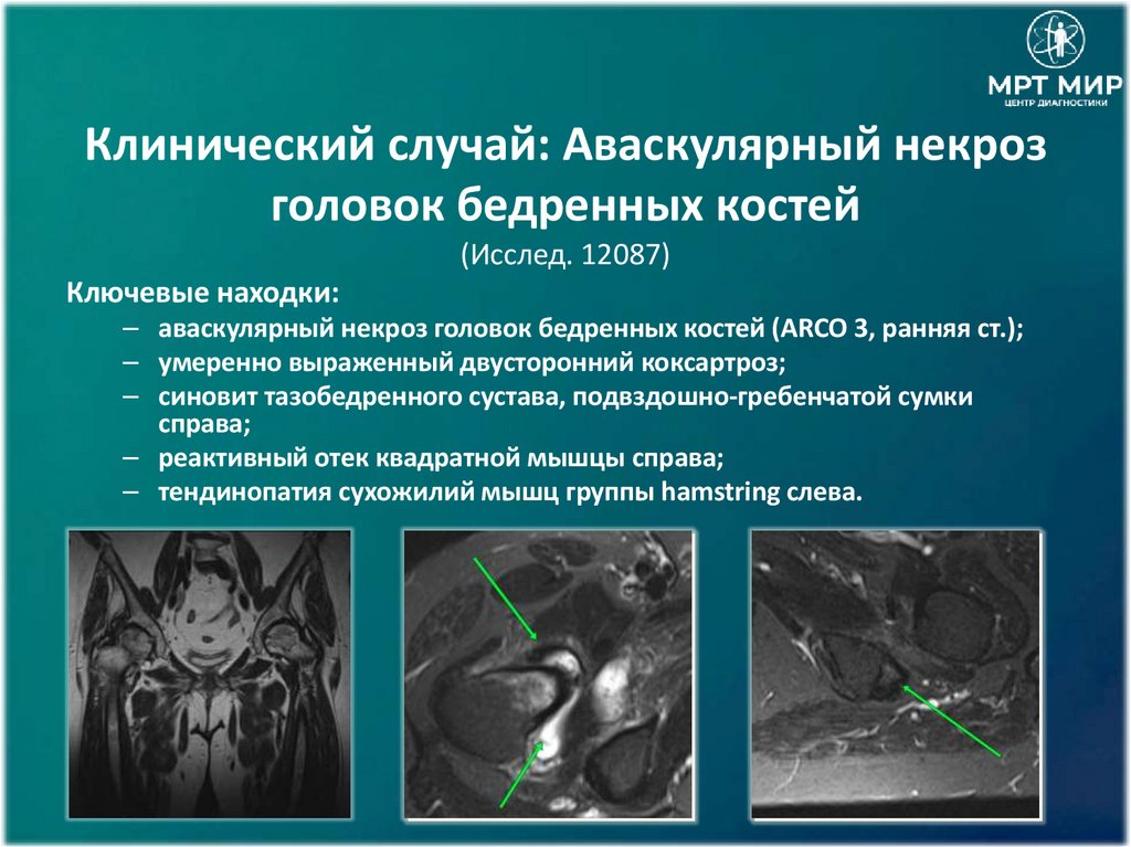 Клинический случай: Аваскулярный некроз головок бедренных костей