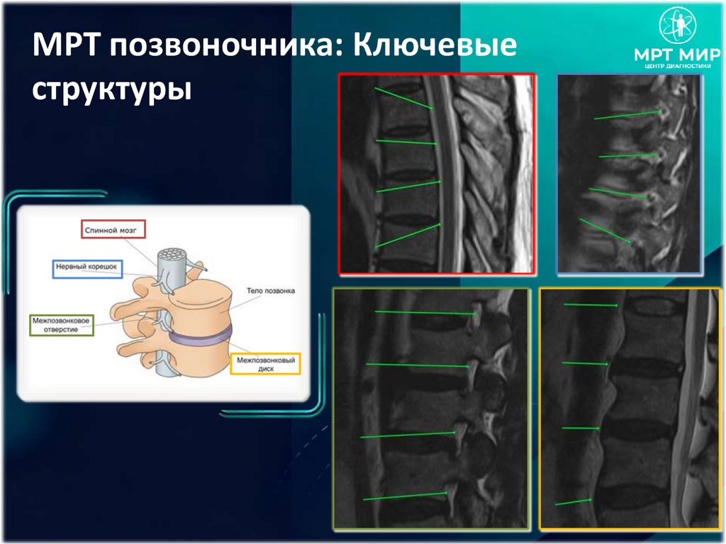 МРТ позвоночника: Ключевые структуры