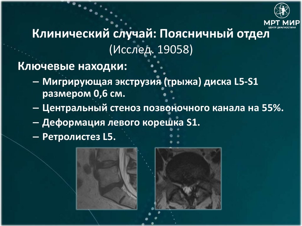 Клинический случай: Поясничный отдел