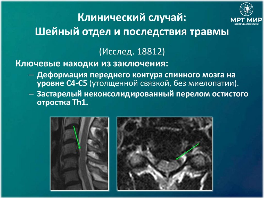 Клинический случай: Шейный отдел и последствия травмы