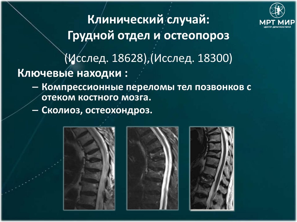 Клинический случай: Грудной отдел и остеопороз
