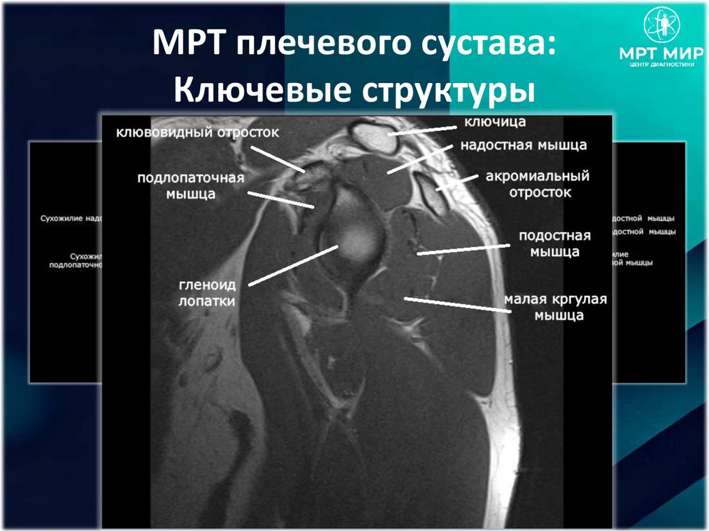 МРТ плечевого сустава: Ключевые структуры
