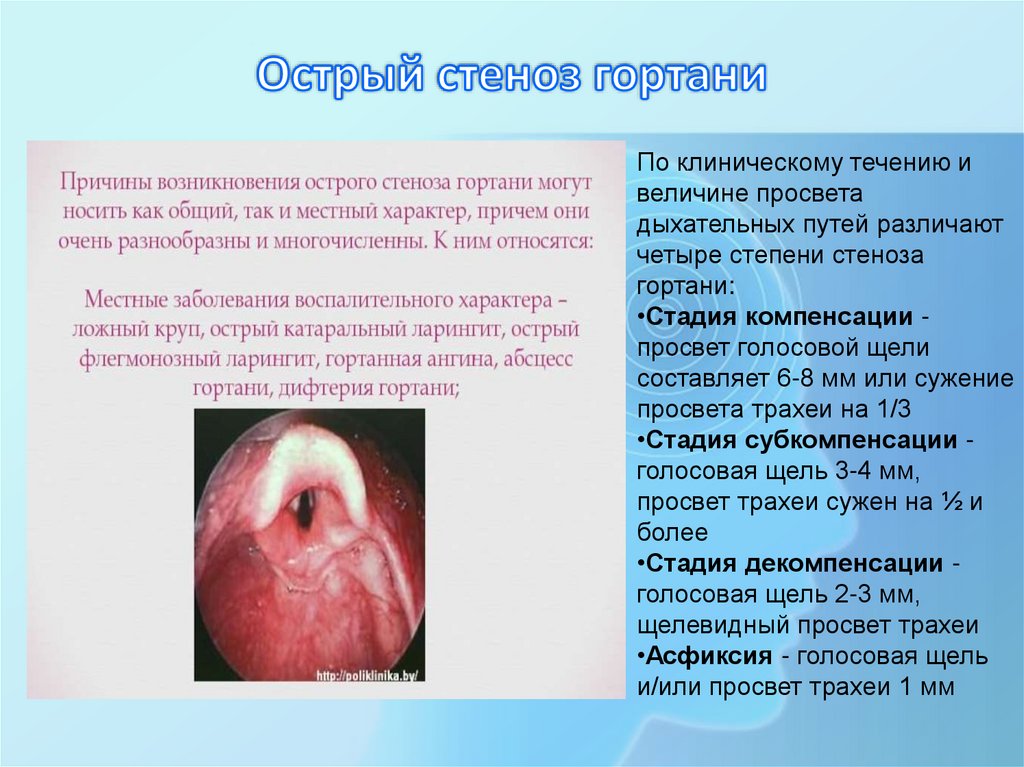 Острый стеноз гортани