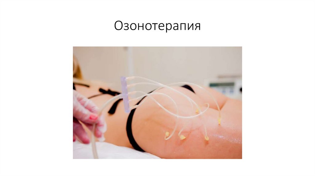 Озонотерапия