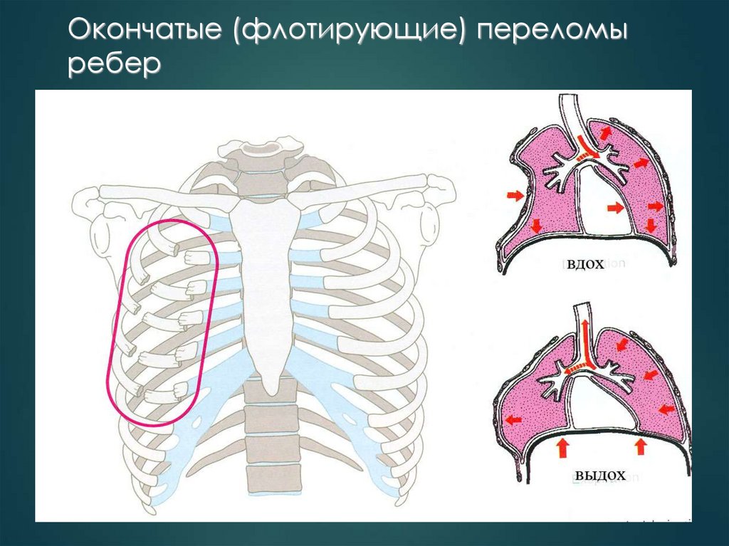 Окончатые (флотирующие) переломы ребер
