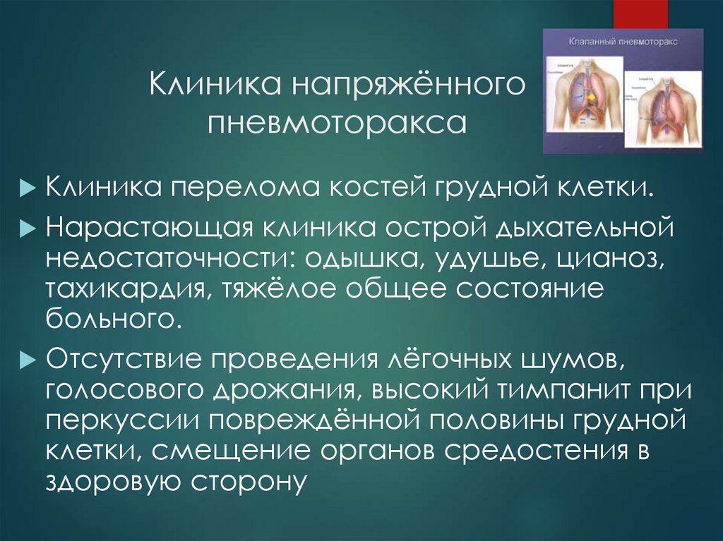 Клиника напряжённого пневмоторакса