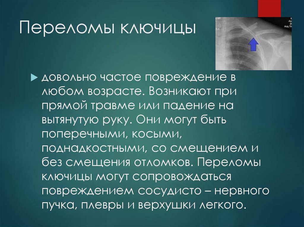 Переломы ключицы