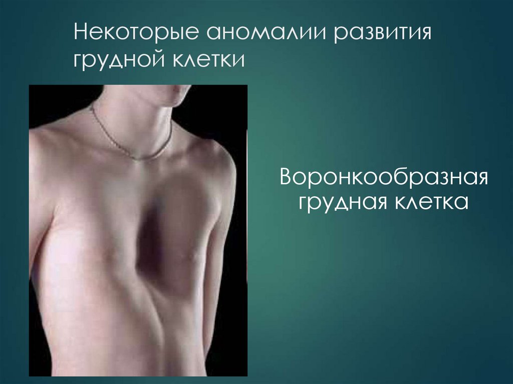 Некоторые аномалии развития грудной клетки