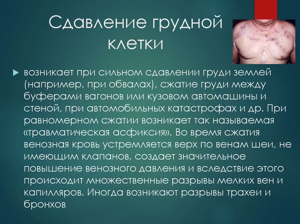 Сдавление грудной клетки