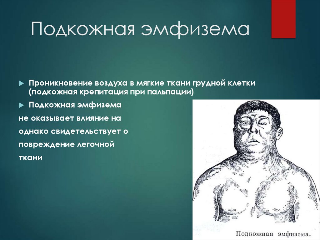 Подкожная эмфизема