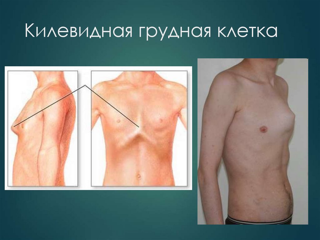 Килевидная грудная клетка