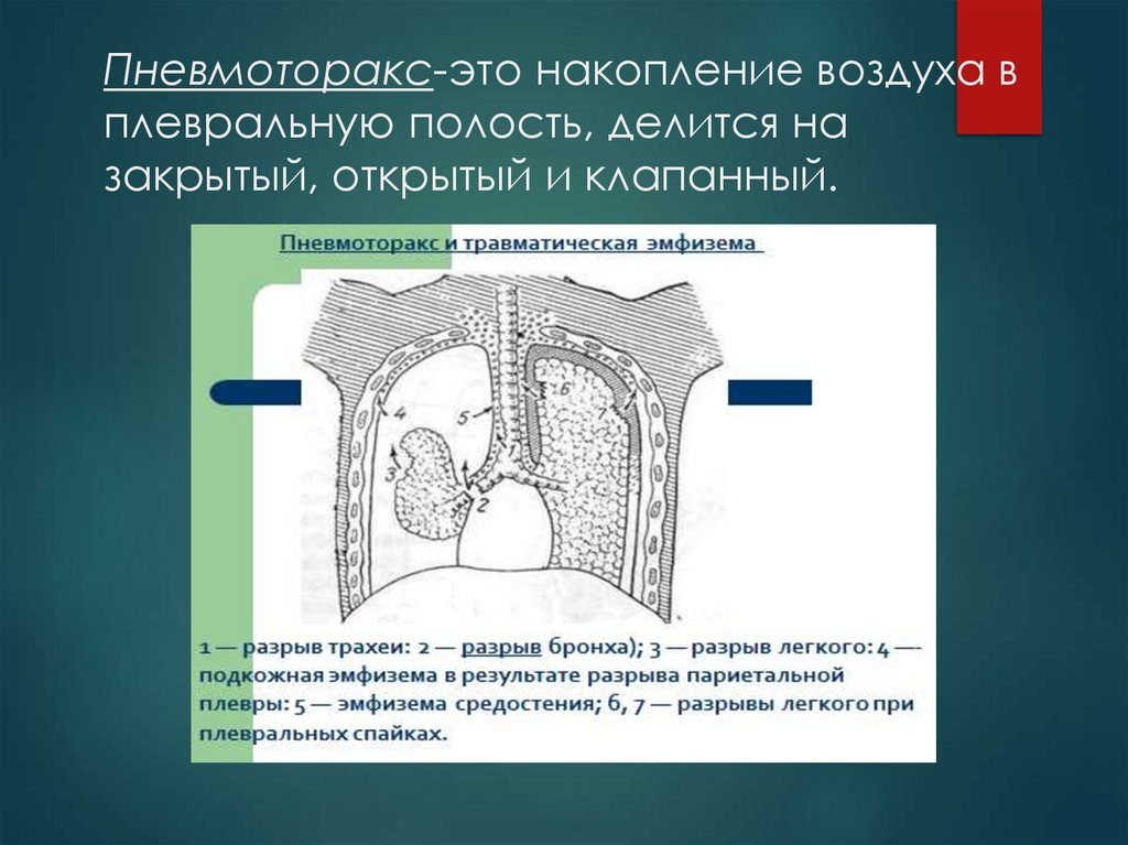 Пневмоторакс-это накопление воздуха в плевральную полость, делится на закрытый, открытый и клапанный.