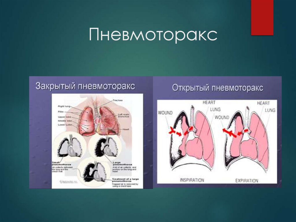 Пневмоторакс