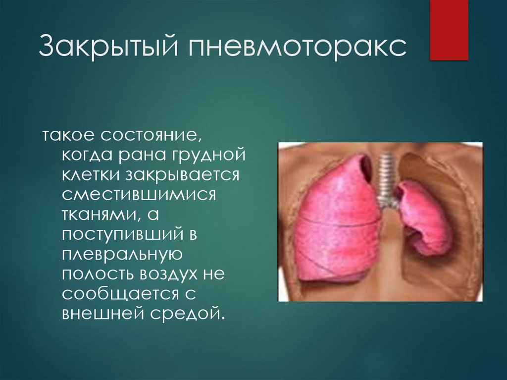 Закрытый пневмоторакс