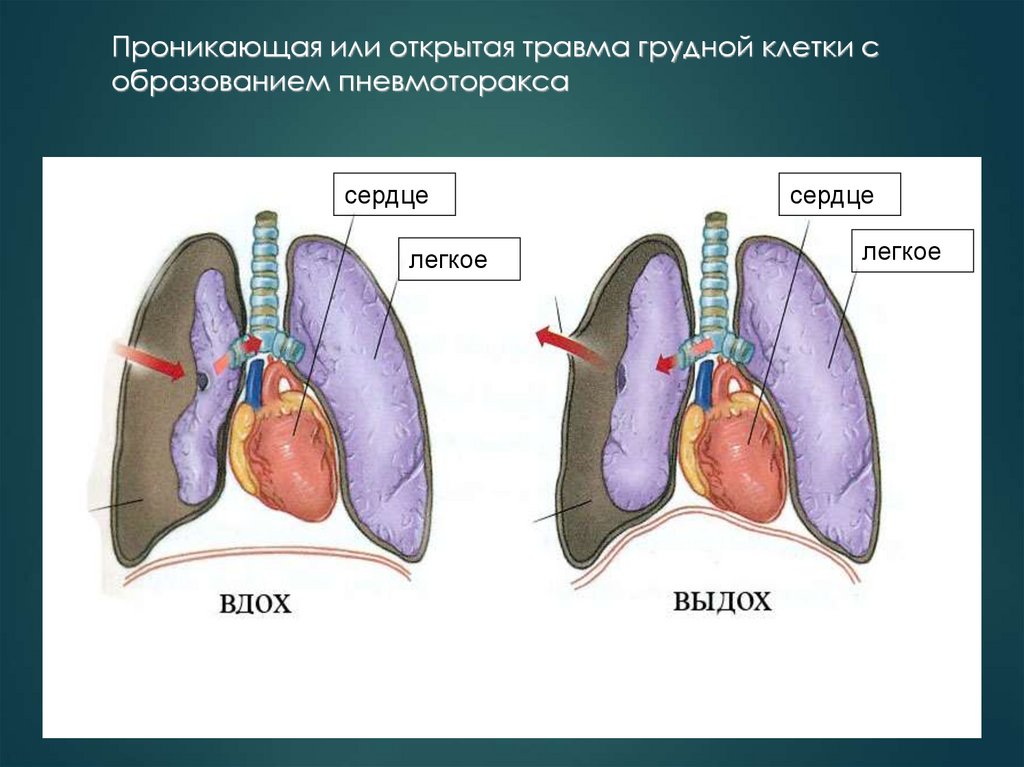 Проникающая или открытая травма грудной клетки с образованием пневмоторакса