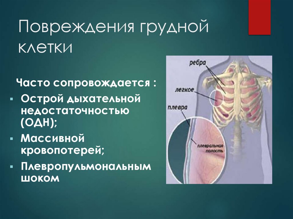 Повреждения грудной клетки