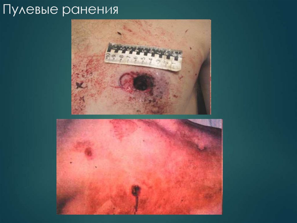 Пулевые ранения