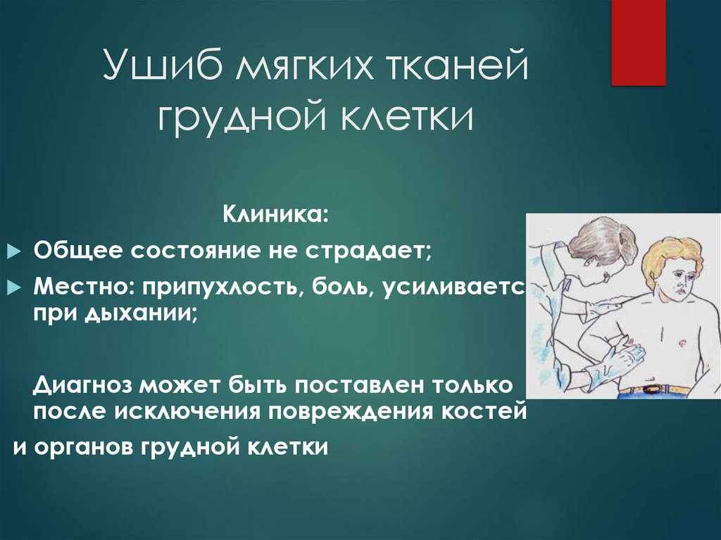 Ушиб мягких тканей грудной клетки