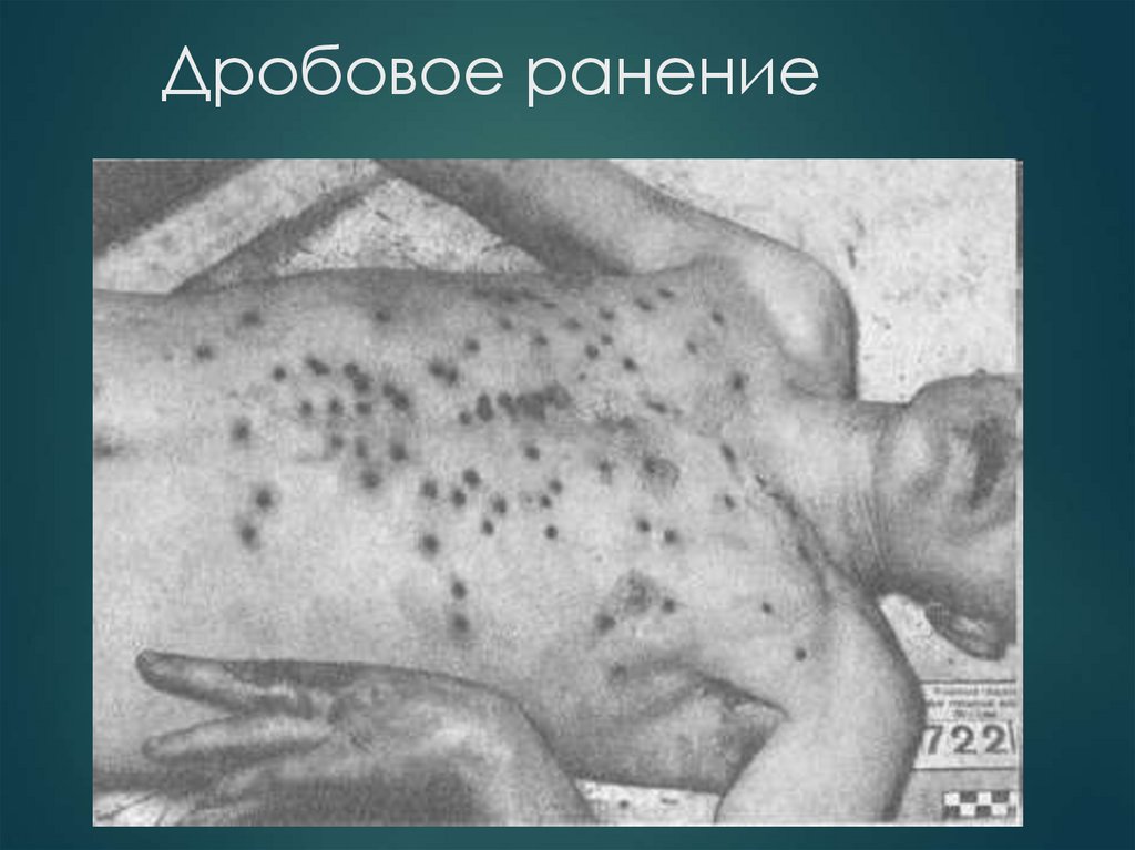 Дробовое ранение