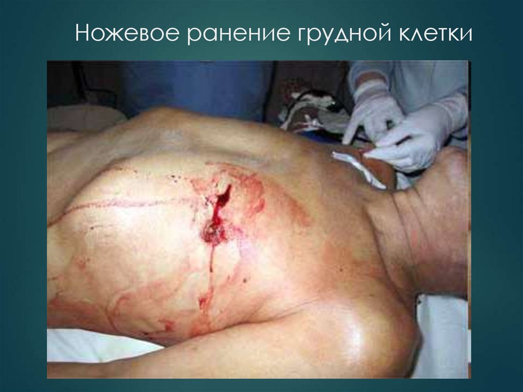 Ножевое ранение грудной клетки