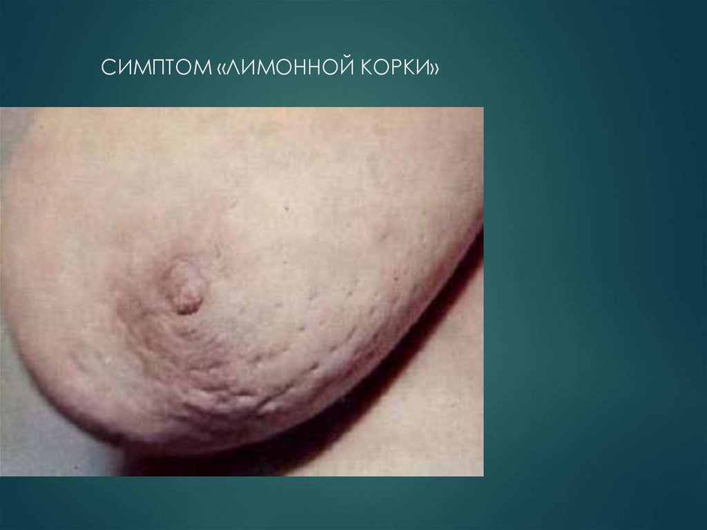 СИМПТОМ «ЛИМОННОЙ КОРКИ»