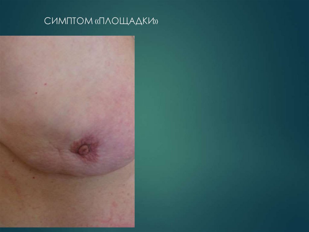 СИМПТОМ «ПЛОЩАДКИ»