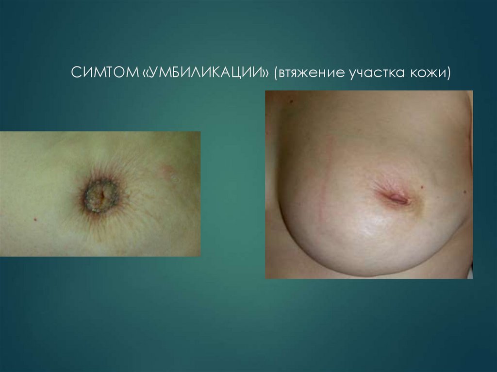 СИМТОМ «УМБИЛИКАЦИИ» (втяжение участка кожи)
