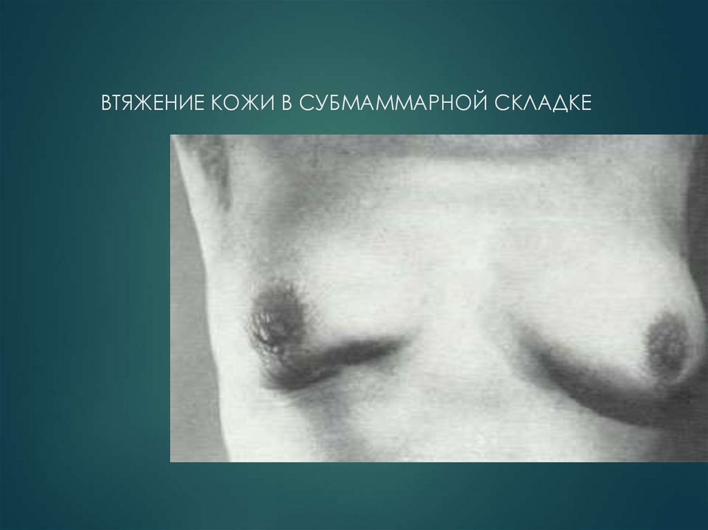 ВТЯЖЕНИЕ КОЖИ В СУБМАММАРНОЙ СКЛАДКЕ