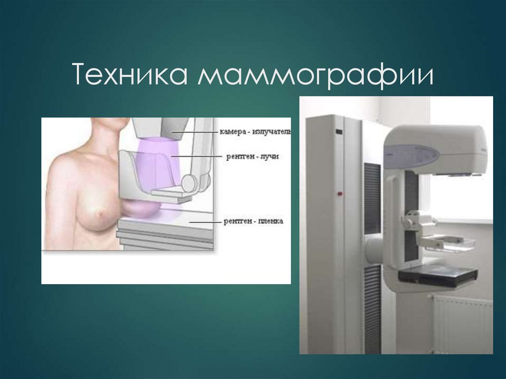 Техника маммографии