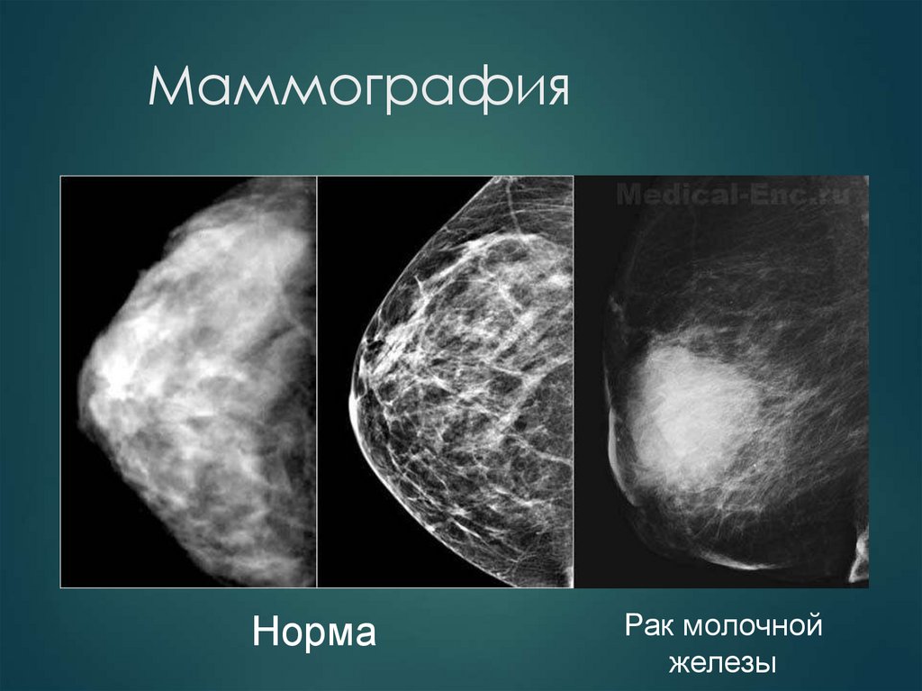 Маммография