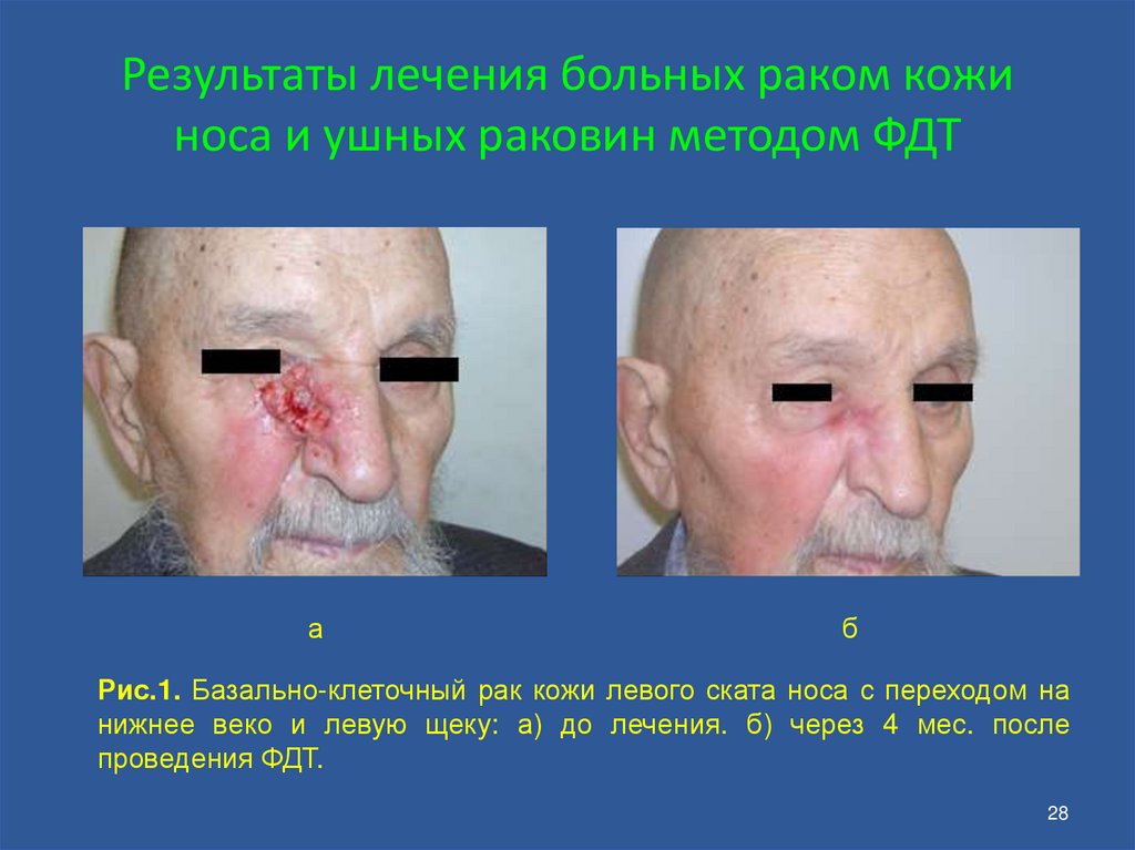 Результаты лечения больных раком кожи носа и ушных раковин методом ФДТ