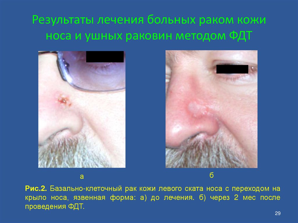Результаты лечения больных раком кожи носа и ушных раковин методом ФДТ