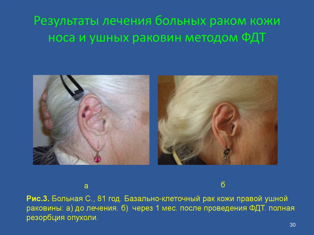 Результаты лечения больных раком кожи носа и ушных раковин методом ФДТ