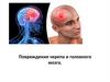 Повреждения черепа и головного мозга
