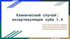 Клинический случай: экзартикуляция зуба 1.4