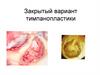 Закрытый вариант тимпанопластики