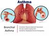 Bronchial Asthma