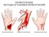 Кровотечения. Методы остановки кровотечений