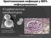 Криптококковая инфекция у ВИЧ инфицированных