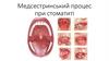 Медсестринський процес при стоматиті