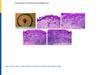 A natural history of melanomas and dysplastic nevi